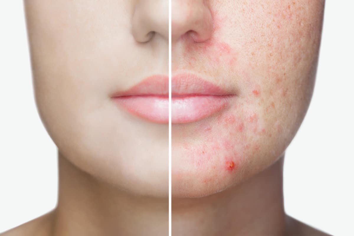 Acne Treatment by Sheperd Integrative Dermatology in Georgetown Road Mount Pleasant SC