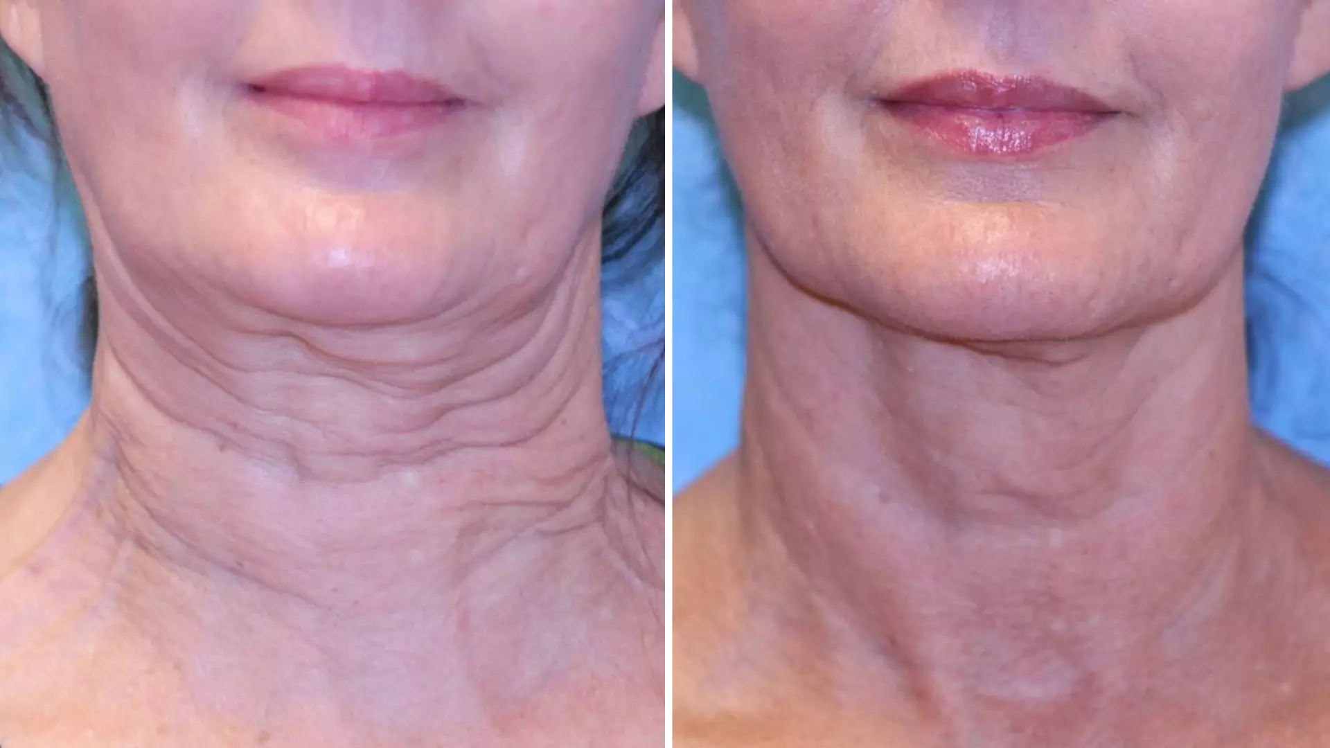 a woman's neck before and after