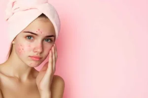 Acne treatment by Glo Esthetics, LLC in Mount Pleasant, SC