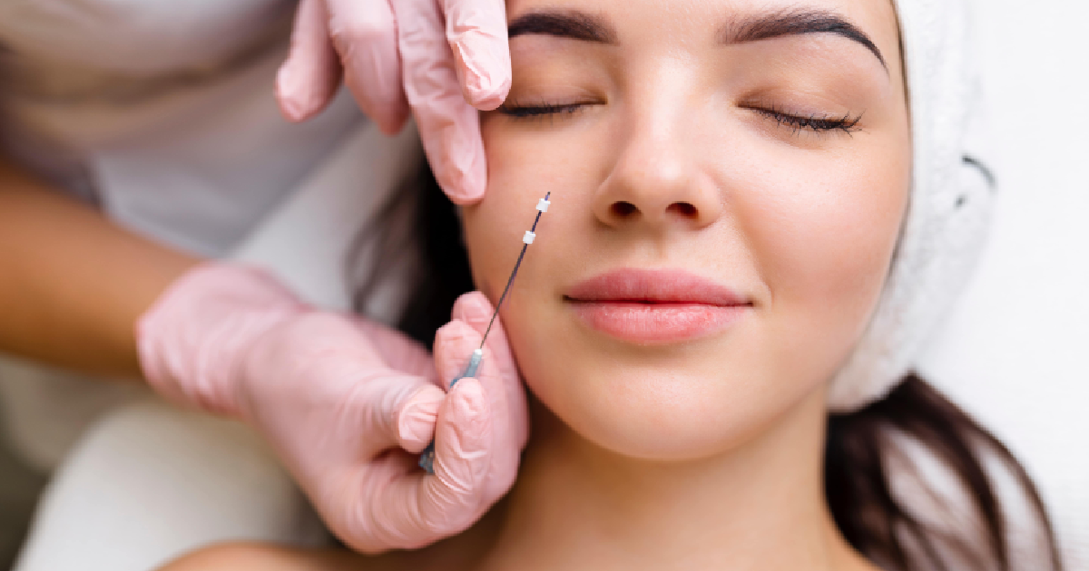 Woman receiving PDO thread lift in Mount Pleasant SC for skin tightening and natural facial rejuvenation.