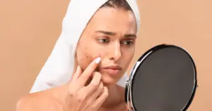 A young woman examines cheek blemishes in a mirror, highlighting acne and acne treatment in Charleston, SC.