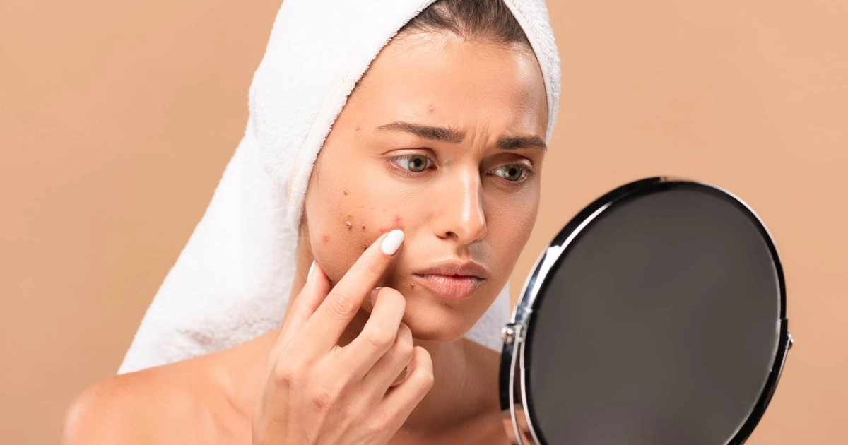 A young woman examines cheek blemishes in a mirror, highlighting acne and acne treatment in Charleston, SC.