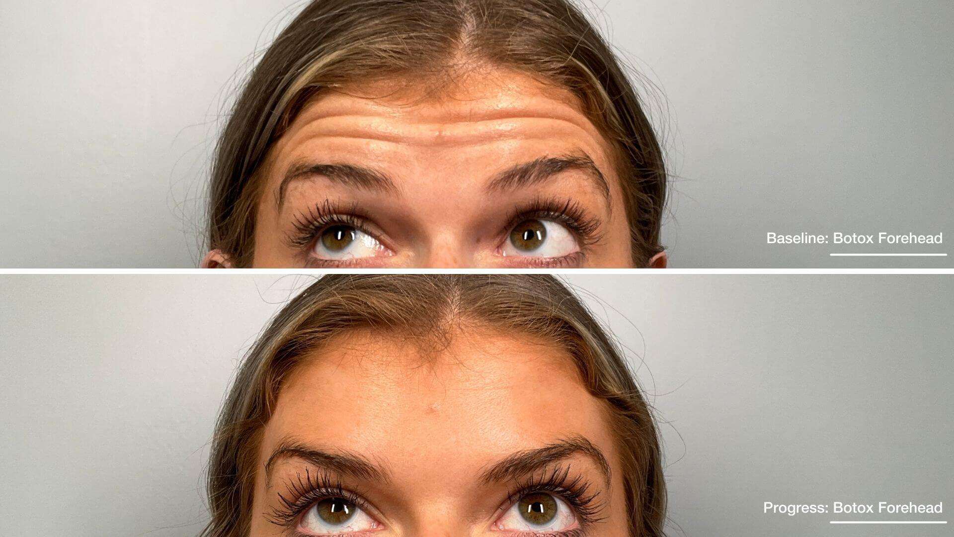 Botox Before and After Treatment Photos | Sheperd Integrative Dermatology in Mount Pleasant, SC