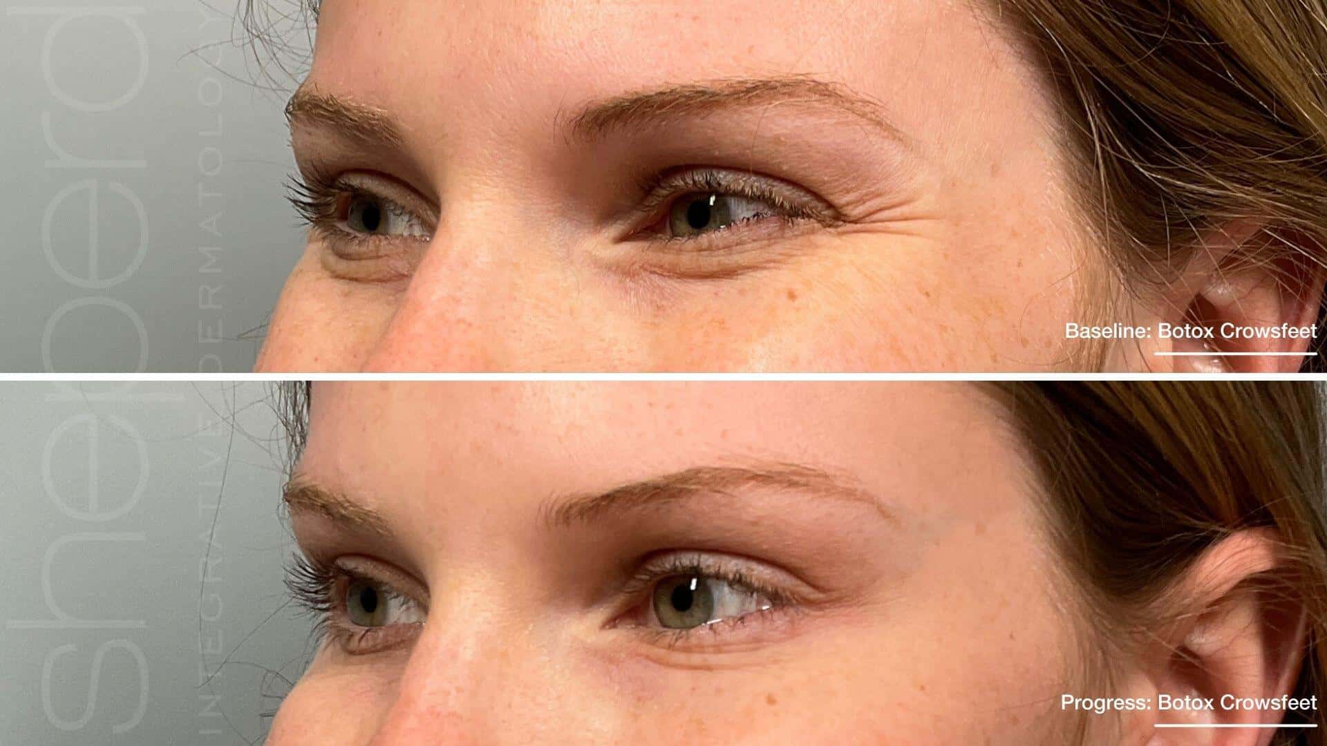 Botox Before and After Treatment Photos | Sheperd Integrative Dermatology in Mount Pleasant, SC
