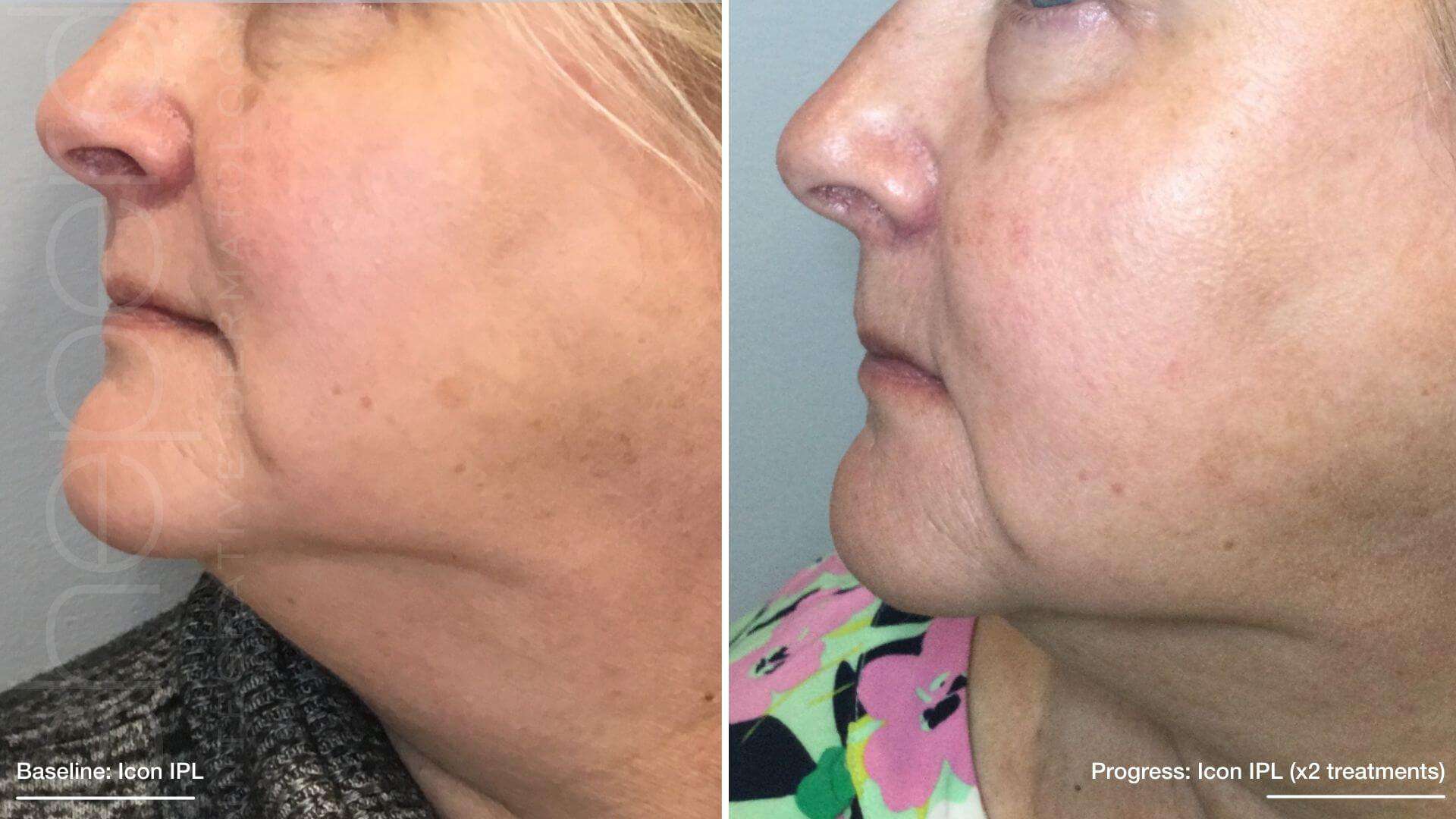 Lasers Before and After Treatment Photos | Sheperd Integrative Dermatology in Mount Pleasant, SC