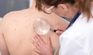 Skin Cancer treatment by Sheperd Integrative Dermatology in Mt. Plesant, SC