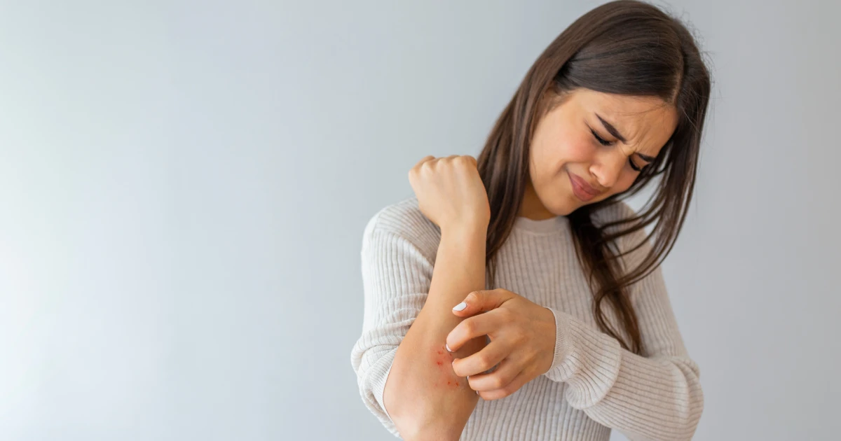 Psoriasis Treatment in Mount Pleasant, SC
