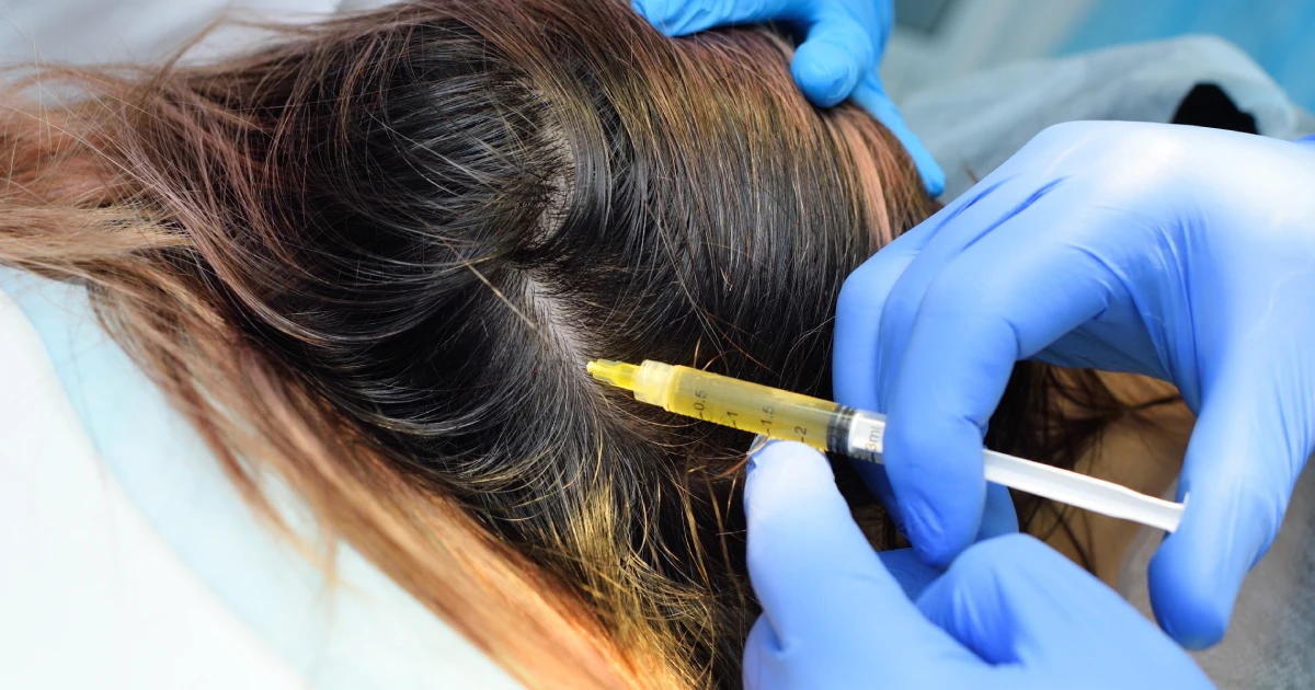 hair restoration treatment plan in Mount Pleasant, SC.